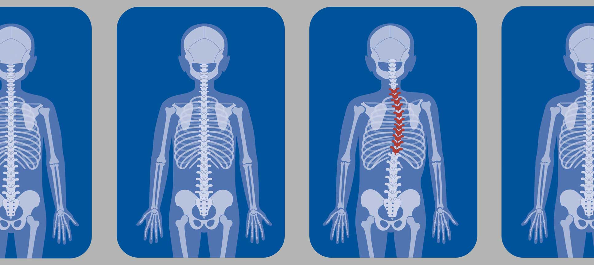 EOS Imaging Reduces Radiation Exposure for Children with Scoliosis