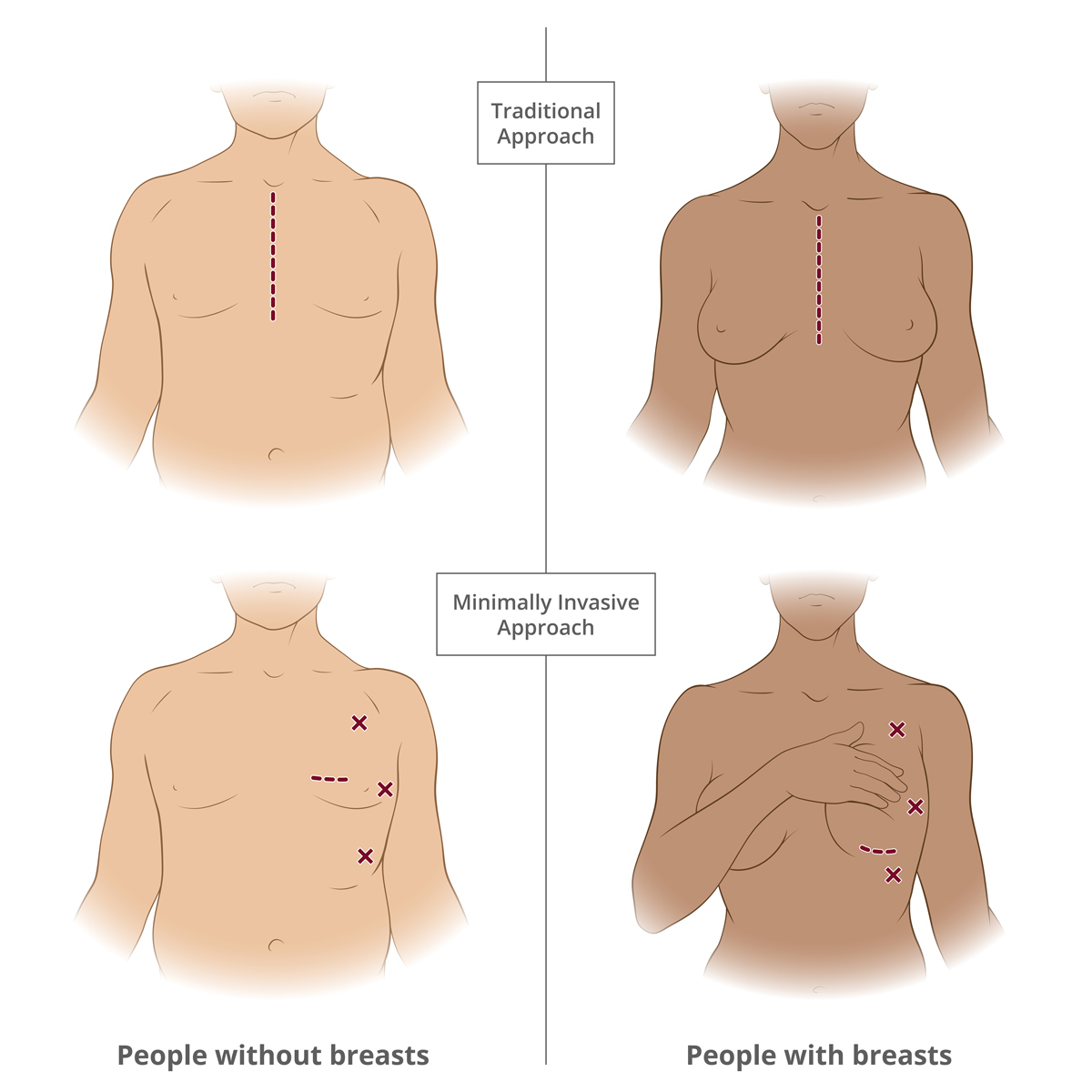 Medical illustrations of the traditional and Minimally Invasive approaches. Each are shown on a person with and without breasts.