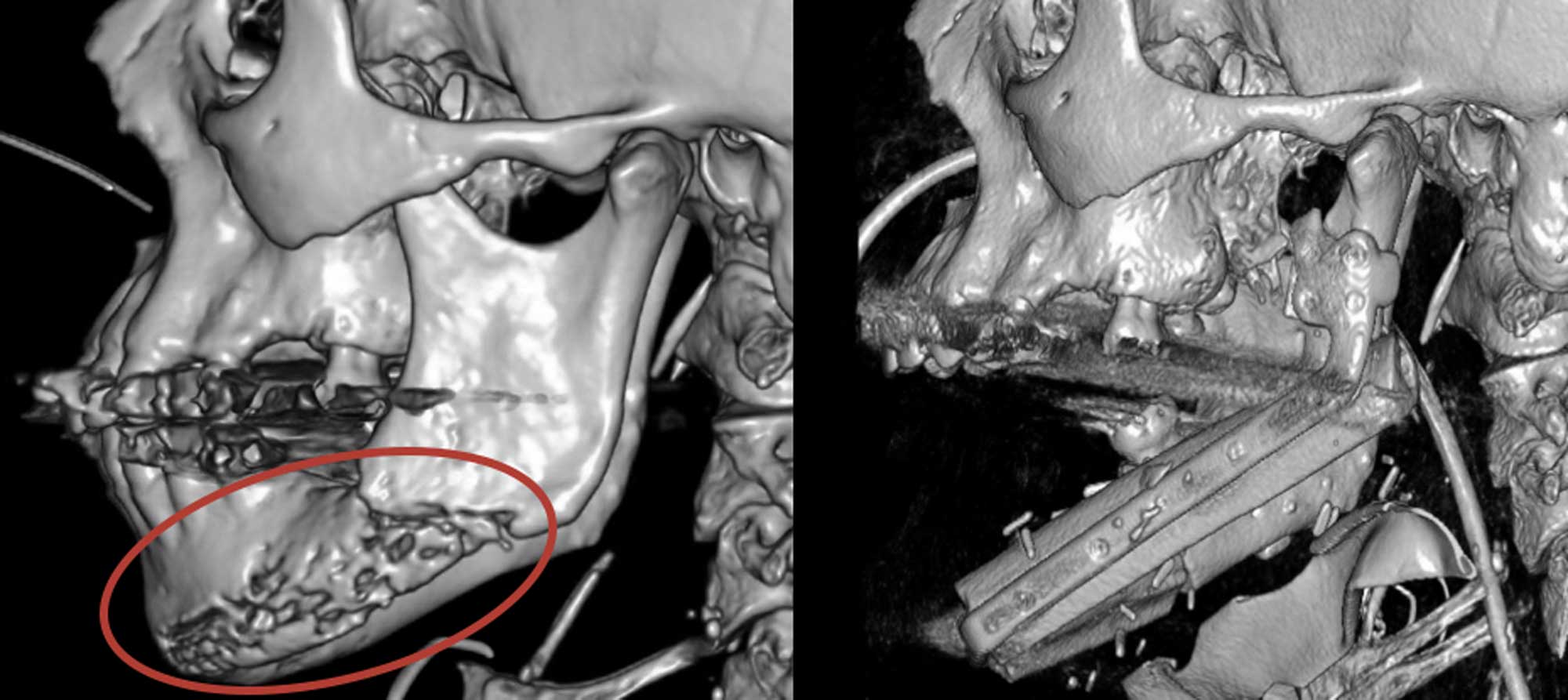 Left, a pre-surgical CT scan shows Roger Floyd’s jawbone with substantial radiation necrosis. Right, a post-surgical CT scan shows Roger Floyd’s jaw after it was replaced with a titanium plate and bone from his leg.