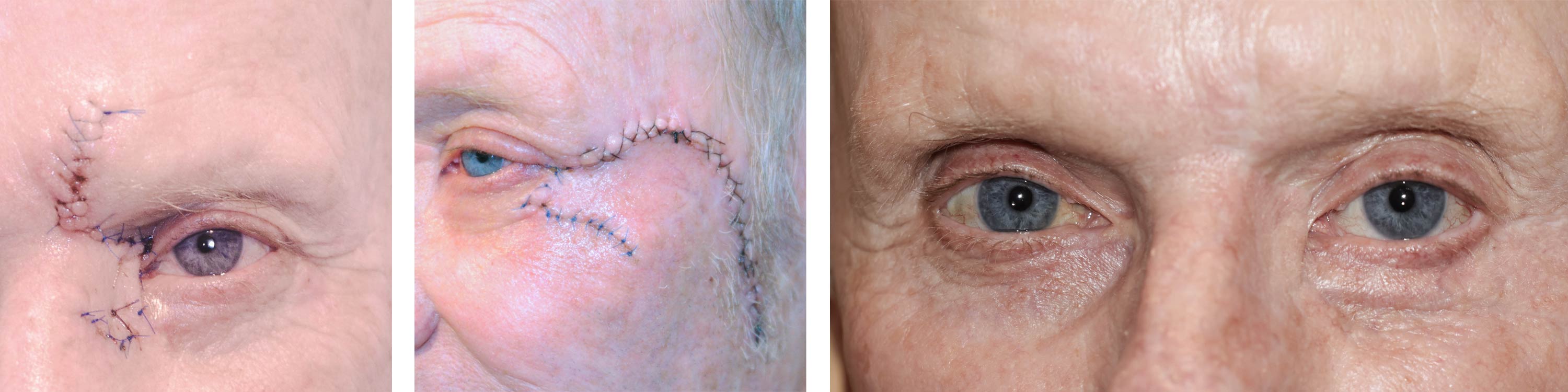 De izquierda a derecha: primer plano de los ojos después de la primera cirugía, aproximadamente una semana después de la segunda cirugía, seis meses después de múltiples cirugías reconstructivas