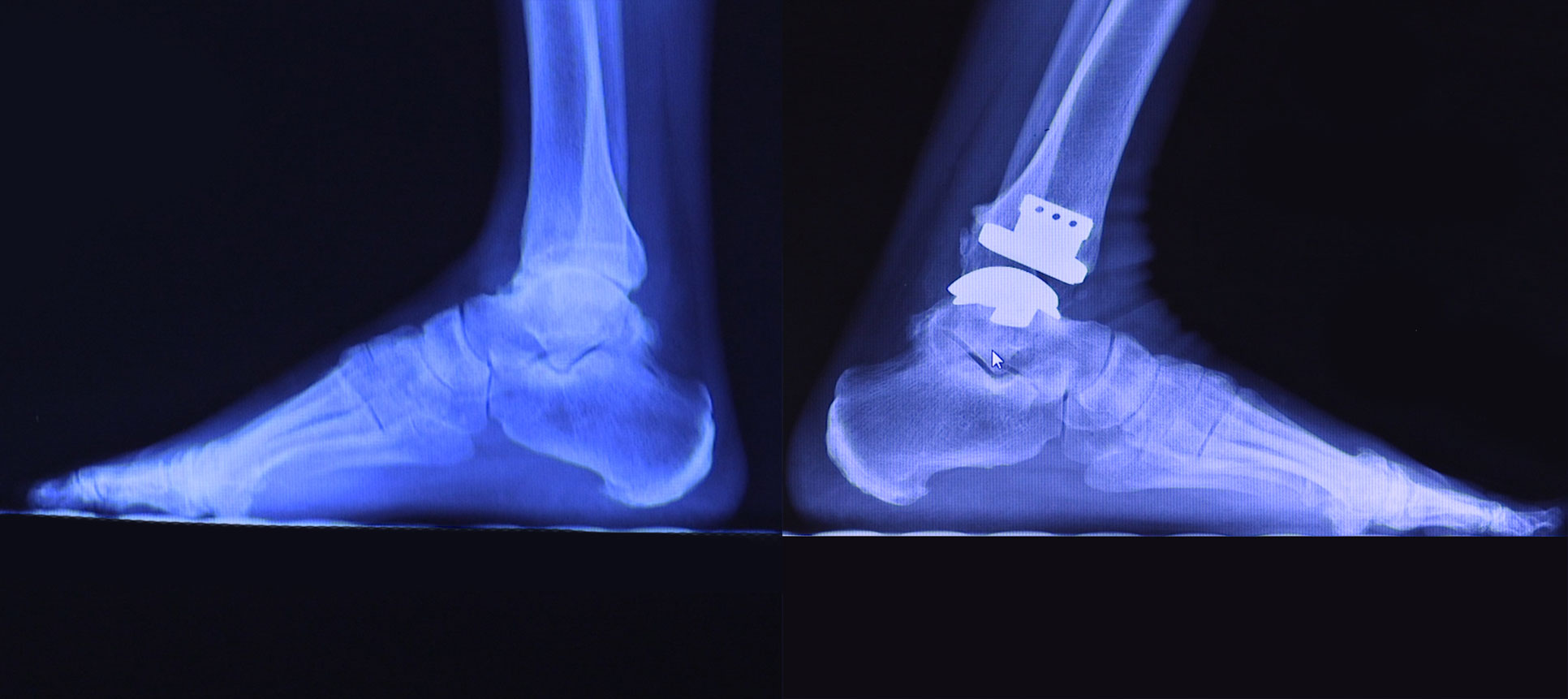 An x-ray taken after Mr. Ashwell's shows his right ankle before surgery and his left ankle after surgery.