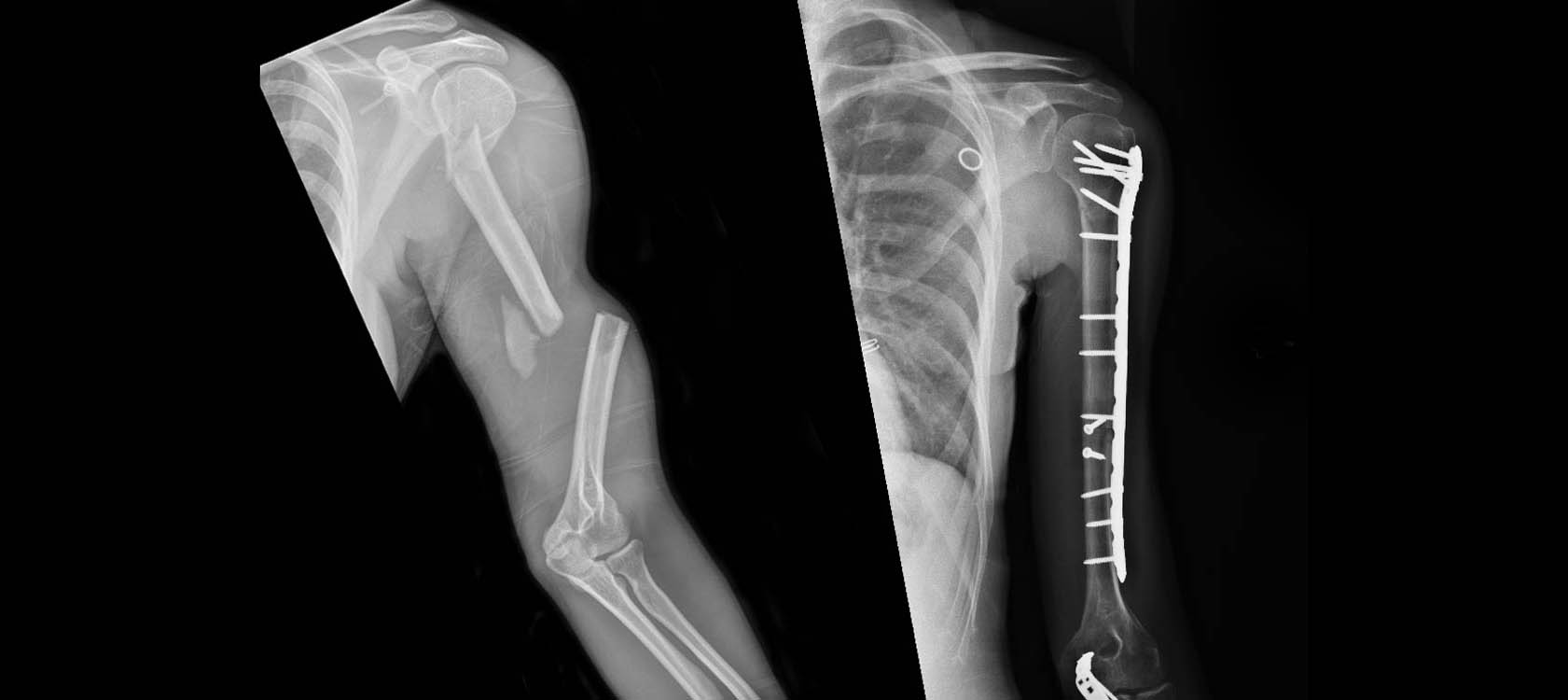 Beth Hufner's X-rays, before and after surgery performed by Grant Garrigues, MD