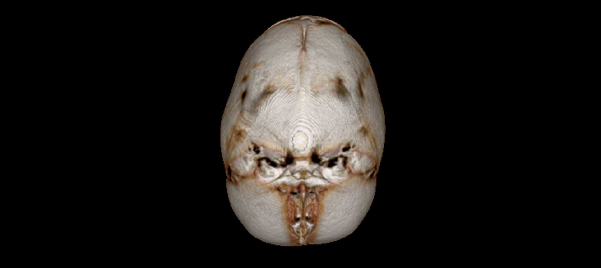 Scan of Luke's skull shows closed sutures 