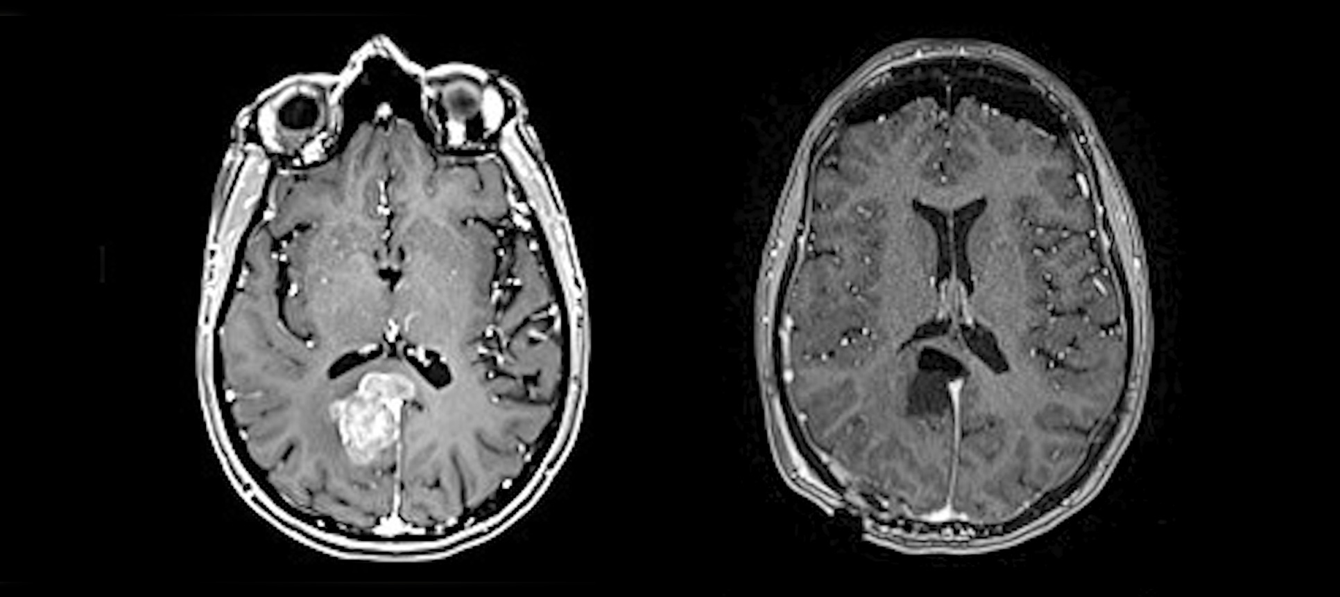 Images of Lisa's brain before and after surgery