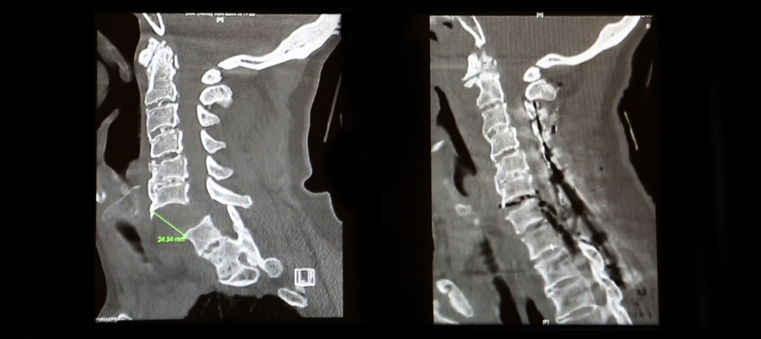 James Clark's spinal column before and after surgery to repair the severed portion
