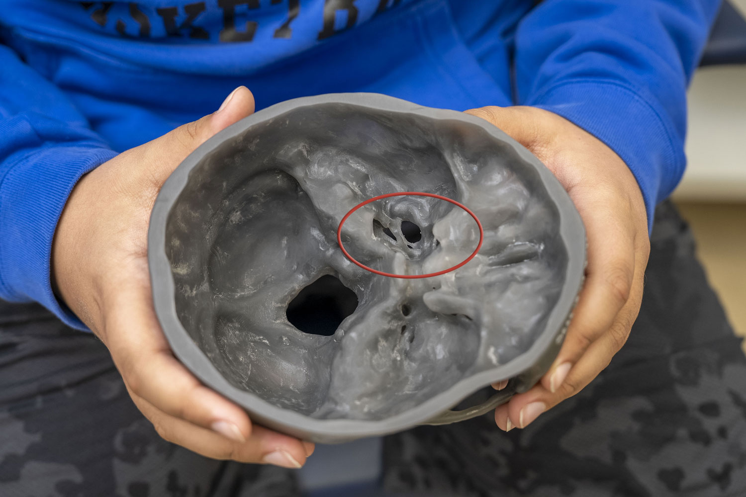 A 3D model of Brayden's skull showing enlarged holes