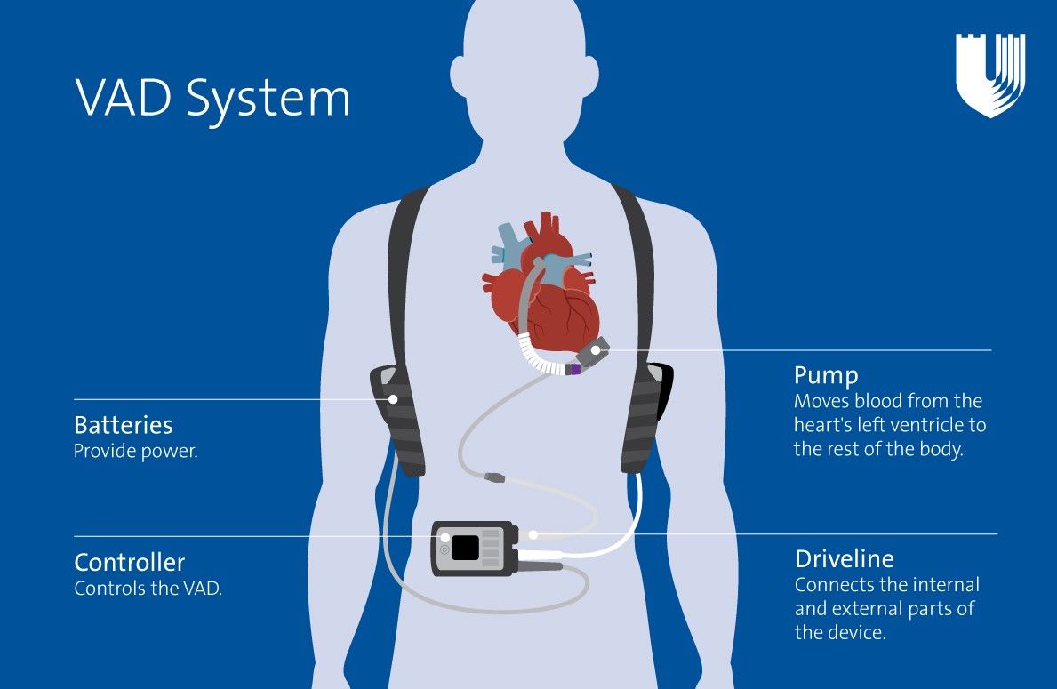 Parts of a VAD system include batteries that provide power, a pump that moves blood from the heart's left ventricle to the rest of the body, a controller that controls the VAD, and a driveline that connects the internal and external parts of the device.