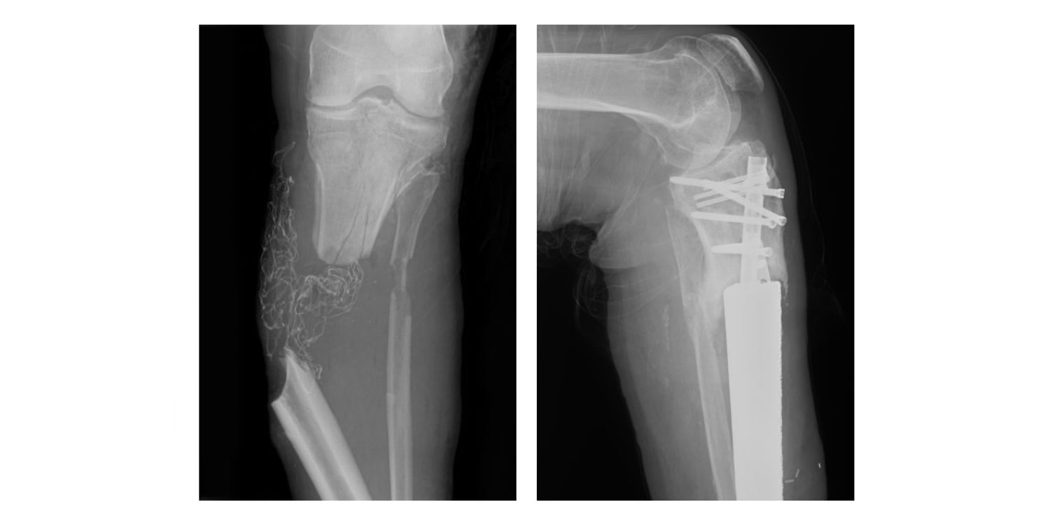 An x-ray of a broken tibia and an x-ray of a repaired tibia