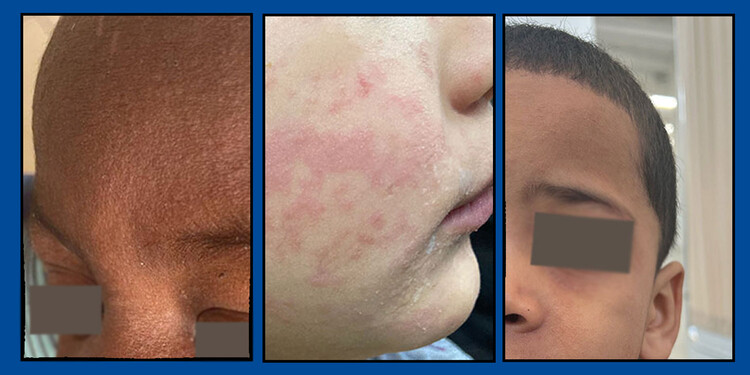 Three images of facial skin rashes