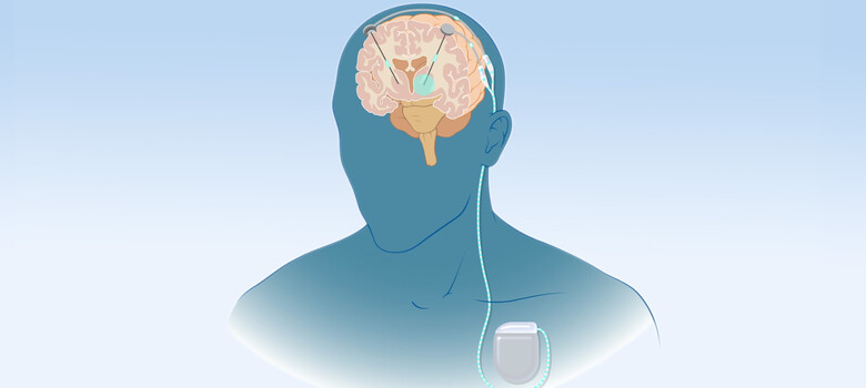 What You Need to Know About Deep Brain Stimulation 