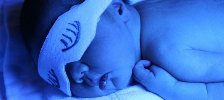Newborn Jaundice 
