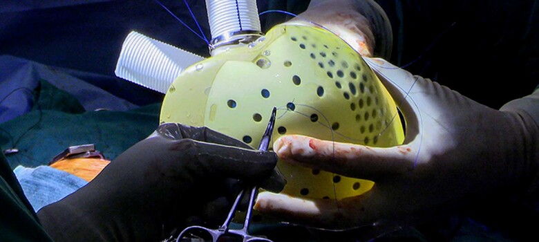 An artificial heart being handled during surgery