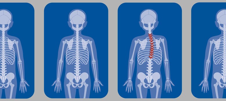 EOS Imaging Reduces Radiation Exposure for Children with Scoliosis