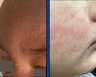 Three images of facial skin rashes