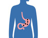 H pylori is a bacteria that can lead to stomach cancer.