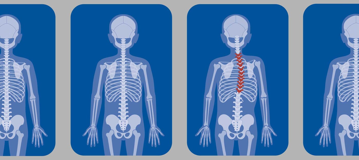 A line of x-rays, one showing scoliosis