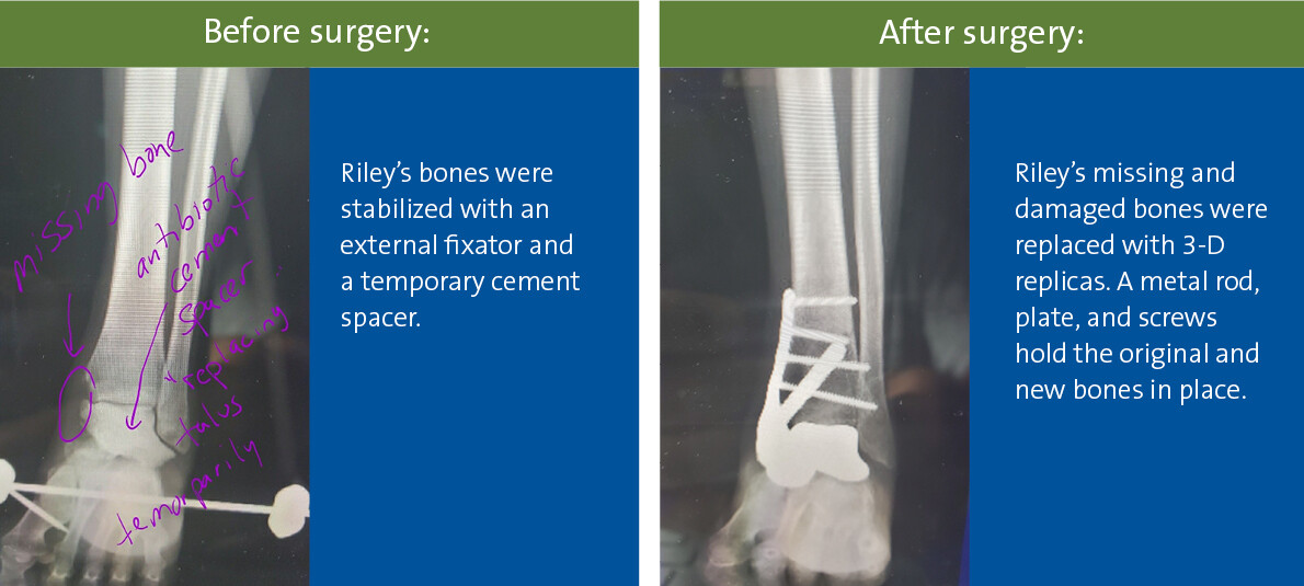 X-rays before and after 3-D talus replacement