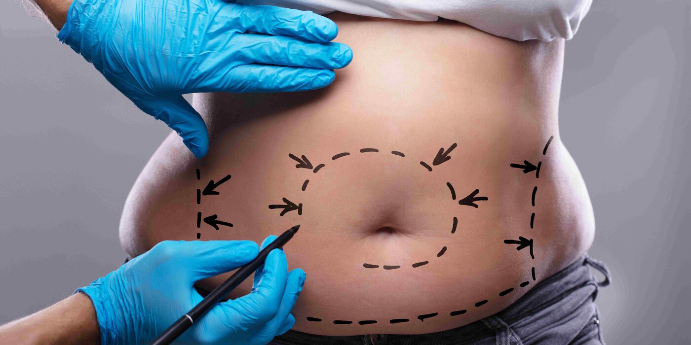 Lines are drawn on a person's stomach to indicate placement for tummy tuck