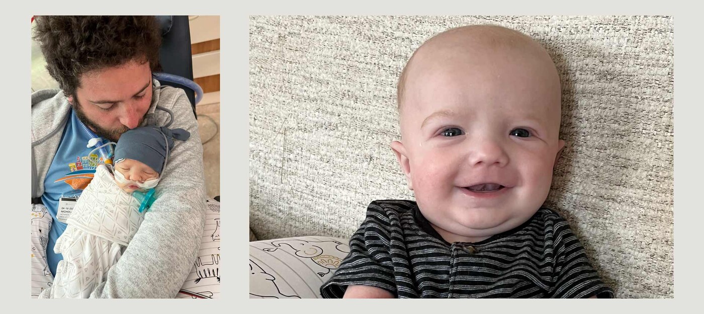 Newborn Owen with his dad before surgery and a second photo of Owen smiling after surgery.