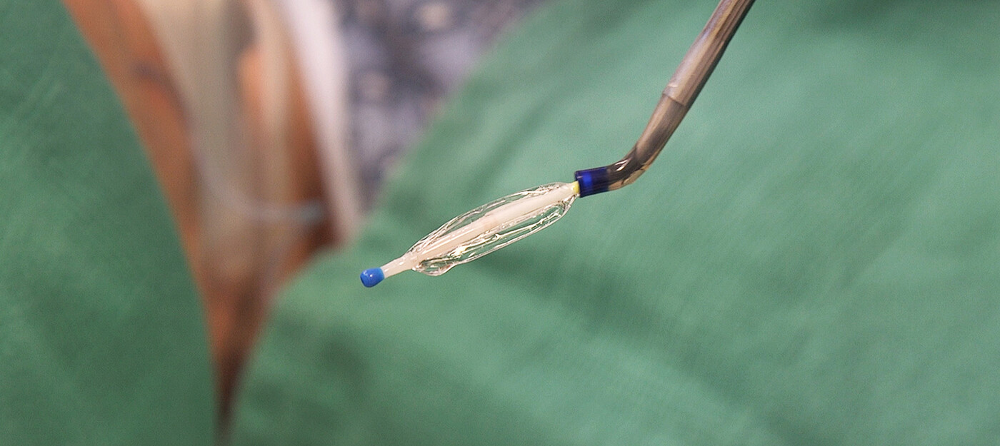 A catheter is used to insert a small balloon through the nose to open a blocked Eustachian tube.