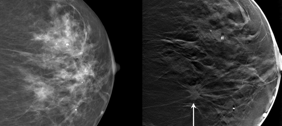 breast cancer digital mammogram