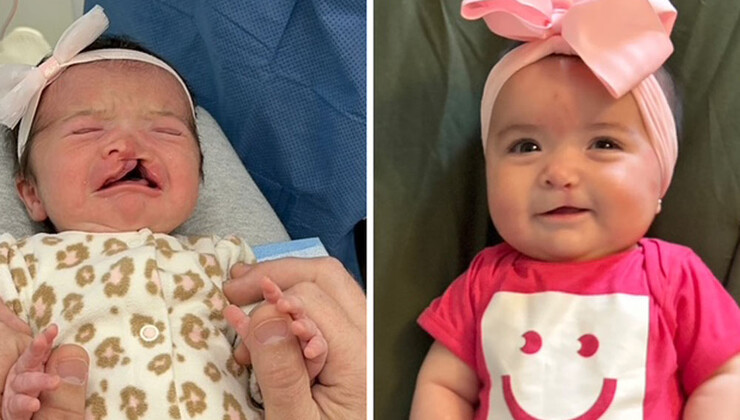 Zoey before and after her cleft lip surgery.